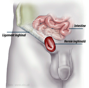 intervenții chirurgicale pentru hernia inghinală și prostatita calcificazioni prostata