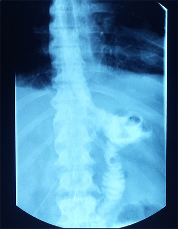 Gastrectomie totala cu esojejunoanastomoza ptr cancer gastric al micii curburi (aspect radiologic postoperator - substanta de contrast trece direct in intestinul subtire)